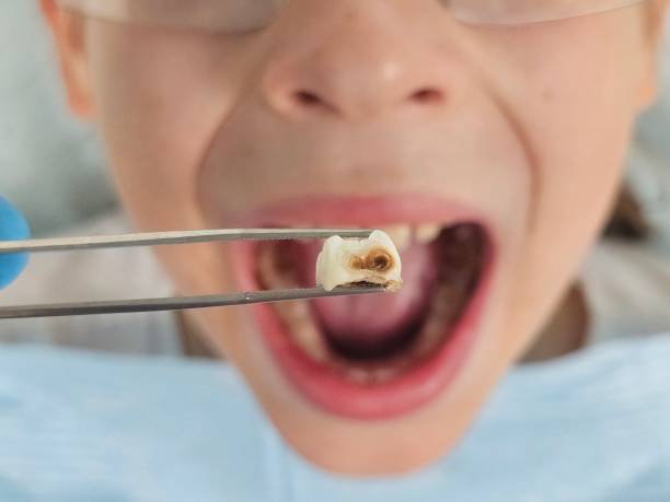 Best Urgent Care for Lost Fillings or Crowns in Center Point, AL